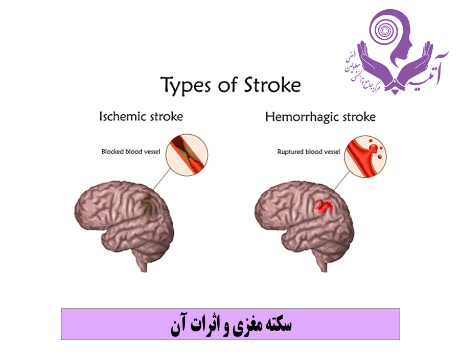 سکته مغزی و اثرات آن