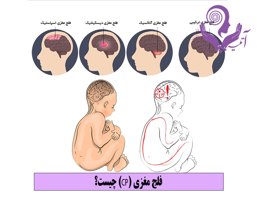  فلج مغزی (CP) چیست؟